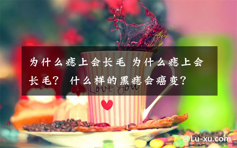 為什么痣上會長毛 為什么痣上會長毛？ 什么樣的黑痣會癌變？