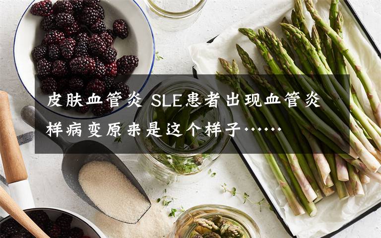 皮膚血管炎 SLE患者出現(xiàn)血管炎樣病變?cè)瓉硎沁@個(gè)樣子……