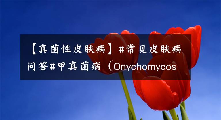 【真菌性皮膚病】#常見皮膚病問答#甲真菌?。∣nychomycosis）