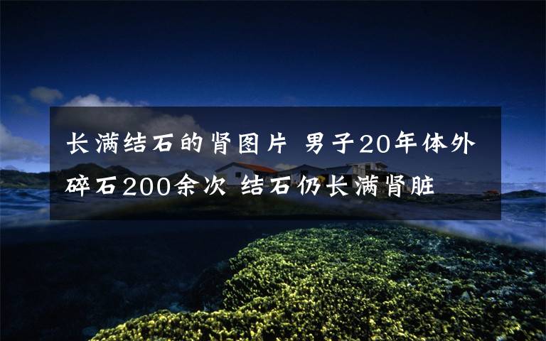 長(zhǎng)滿結(jié)石的腎圖片 男子20年體外碎石200余次 結(jié)石仍長(zhǎng)滿腎臟