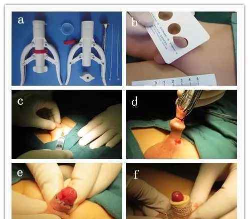 幼兒包莖的圖片 兒童包皮環(huán)切術(shù)手術(shù)過程