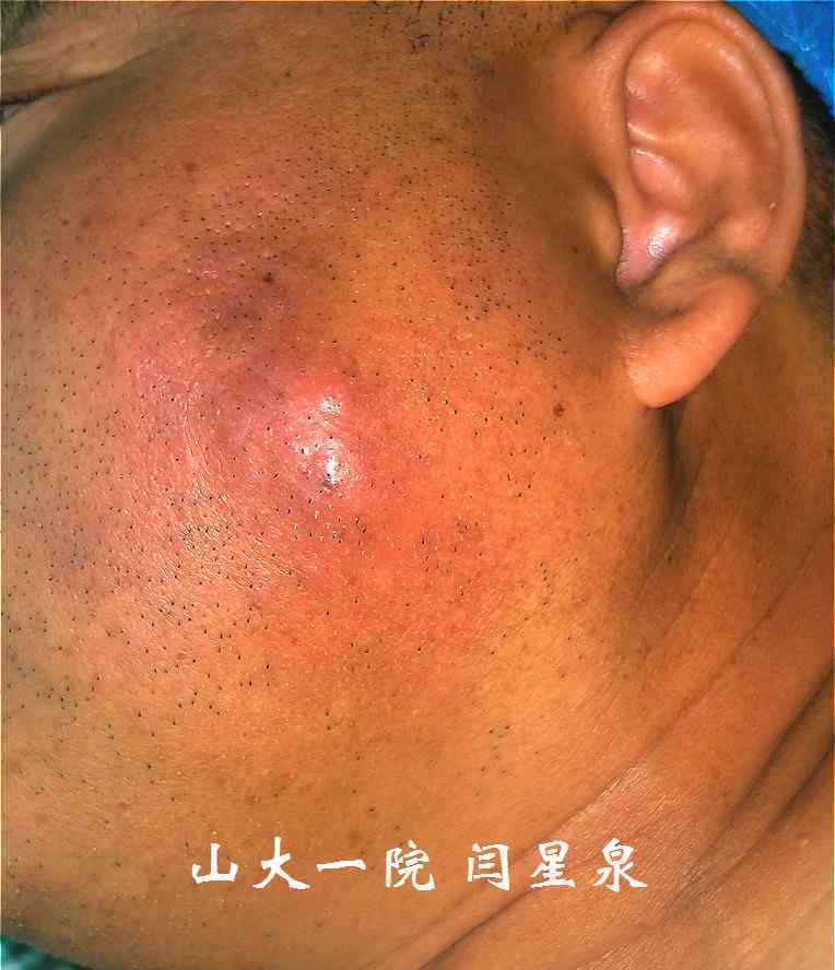 化膿性腮腺炎 史上最直觀的——化膿性腮腺炎切開引流術(shù)——從理論到實(shí)踐