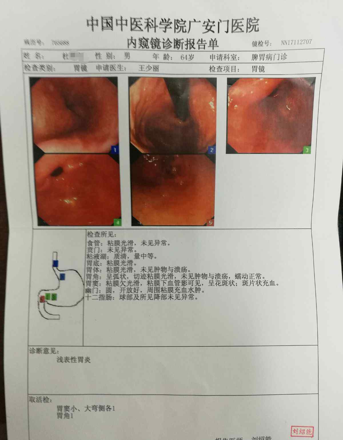 慢性萎縮性胃炎治療 重度慢性萎縮性胃炎伴重度腸化生治療三個月余逆轉(zhuǎn)為淺表性胃炎