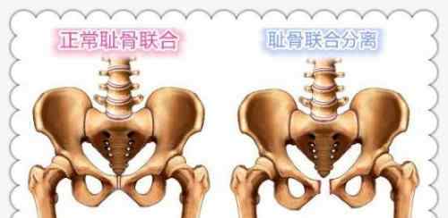 恥骨疼 多么痛的領悟——恥骨聯(lián)合分離疼痛