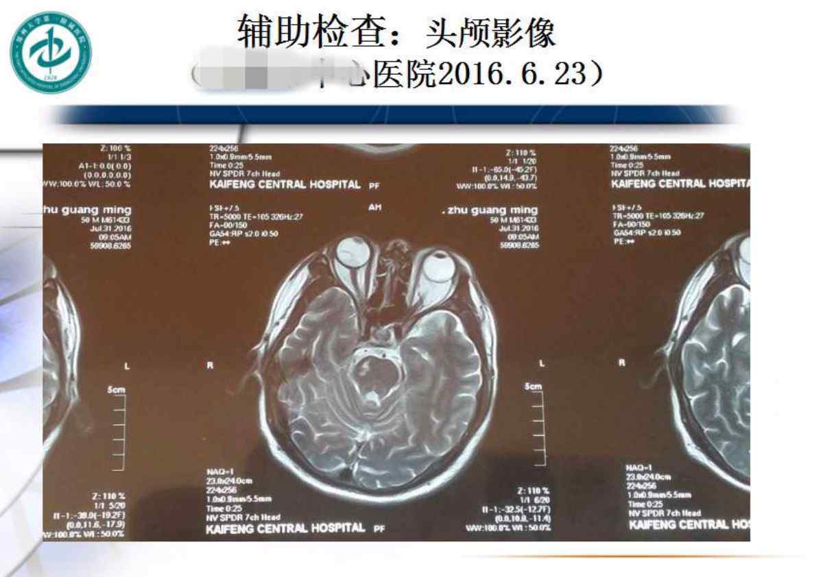 頑固性呃逆首選藥 頑固性呃逆治療顯奇效