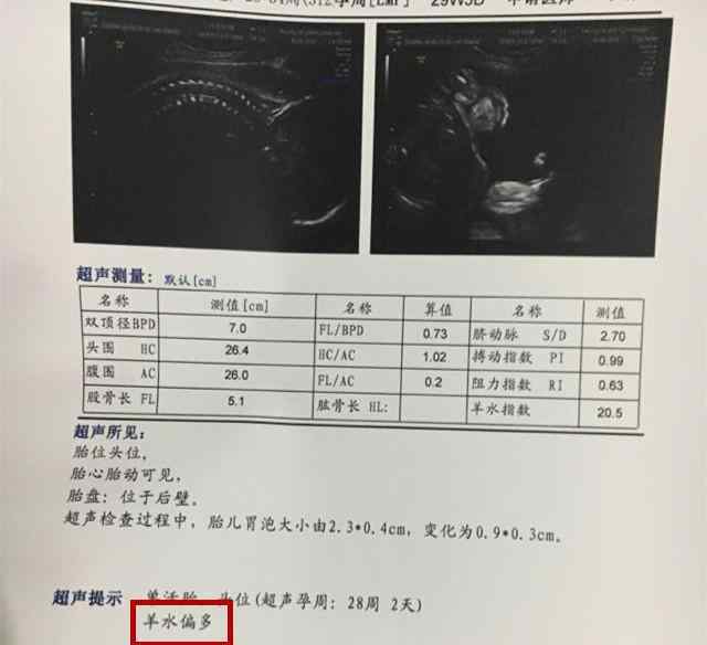 羊水太多也不好?懷孕期間“羊水偏多”有風(fēng)險(xiǎn)性,孕媽媽提早掌握