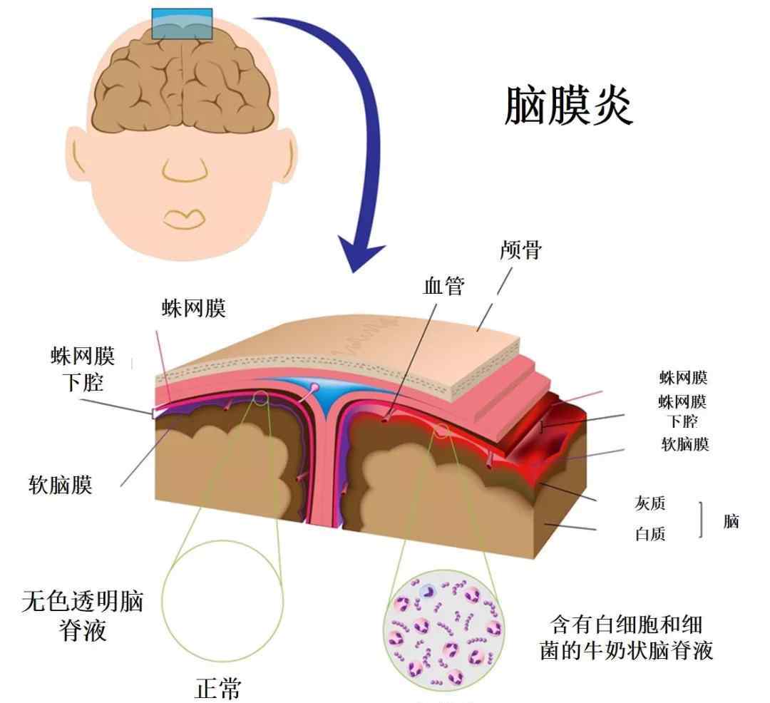 腦膜炎球菌心肌炎臨床流行病學(xué)