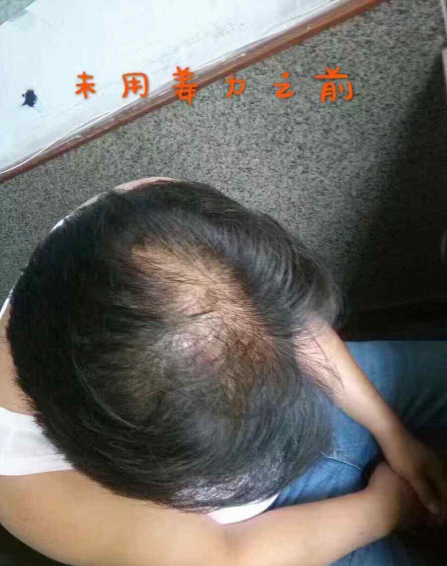 頭發(fā)頭頂少 頭頂漩渦為什么頭發(fā)少？