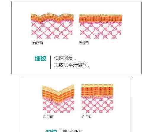 歐州做面部微雕提升面部美容護膚和其他細胞再生醫(yī)工藝