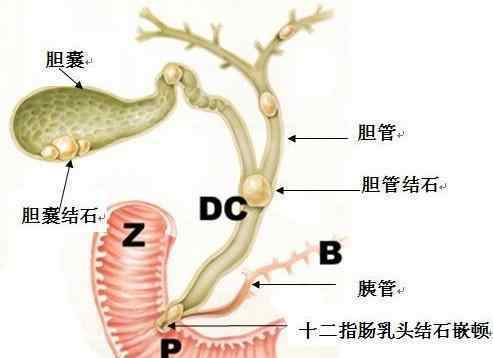 外國人對膽囊切除觀點切膽不良影響太比較嚴重,一定要三思!