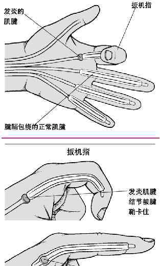 “扳機(jī)指”的別的醫(yī)治如保守治療失效