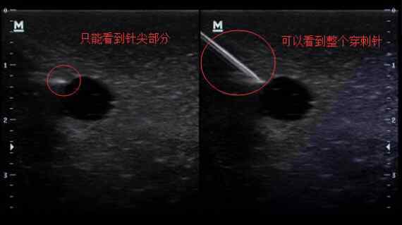 穿刺針 邁瑞超聲功能介紹之穿刺針增強