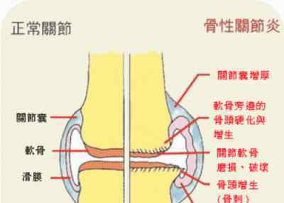 容易得到骨關節(jié)炎的群體