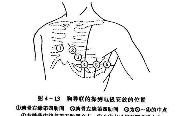 心電圖導(dǎo)聯(lián)位置顏色 【圖】心電圖導(dǎo)聯(lián)位置圖解大全 心電圖導(dǎo)聯(lián)連接快速確定位置