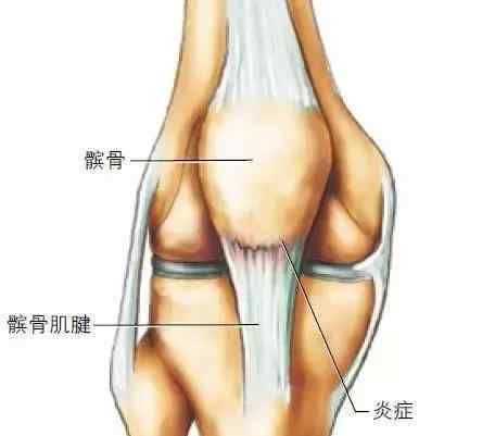 關(guān)節(jié)損傷 最全干貨！跑者常見的6個(gè)膝關(guān)節(jié)損傷指南