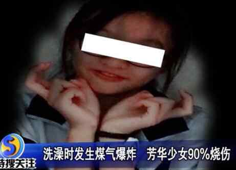 火人 慘不忍睹！少女洗澡煤氣爆炸 17歲女孩出來時全身上下已是“火人”