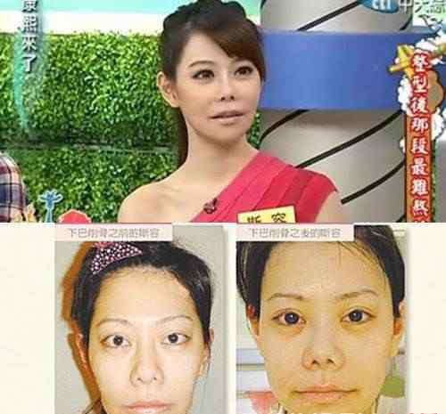 斯容整容前后 女星整形容貌走樣 盤點整容失敗的女星誰最慘