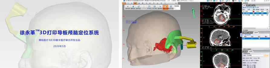 徐永革 3D打印導板輔助腦出血微創(chuàng)手術    黑焰與徐永革團隊助力基層醫(yī)院