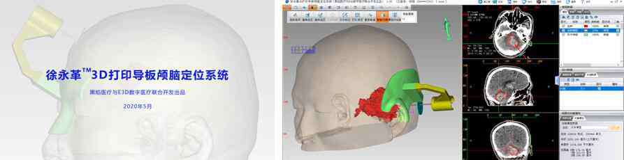 徐永革 3D打印導(dǎo)板輔助腦出血微創(chuàng)手術(shù)    黑焰與徐永革團(tuán)隊(duì)助力基層醫(yī)院