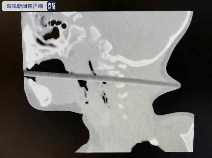 揪心！2歲幼童吃蘋果被筷子貫穿喉部 從后頸戳了出來 奶奶瞬間嚇傻