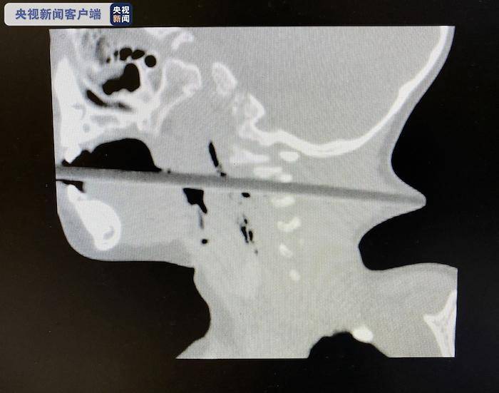 揪心！2歲幼童吃蘋果被筷子貫穿喉部 從后頸戳了出來 奶奶瞬間嚇傻