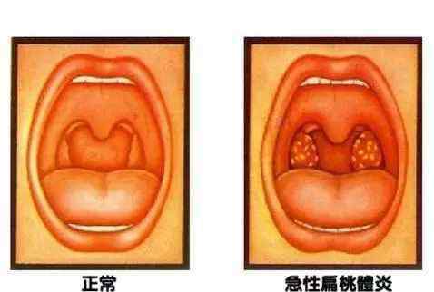 免疫器官 歌手張咪癌癥晚期，這個經常發(fā)炎的免疫器官，也可能得癌