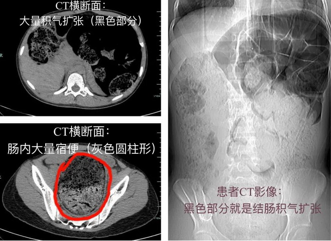 女高中生長(zhǎng)期便秘 一查子宮都被擠偏！治療后 她一夜輕了8斤