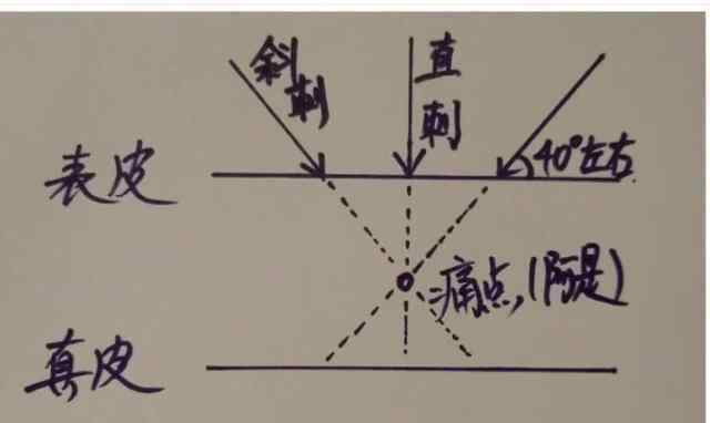 釷怎么讀 黃帝內(nèi)針怎么扎？說說我理解的進(jìn)針方法