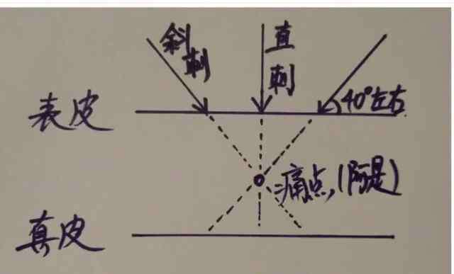 釷怎么讀 黃帝內(nèi)針怎么扎？說說我理解的進針方法