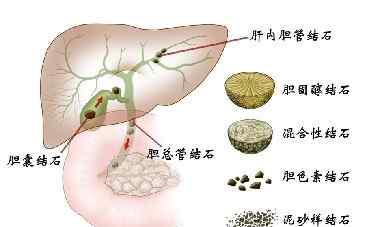 泥沙樣膽結(jié)石如何治療 泥沙型膽結(jié)石怎么治療