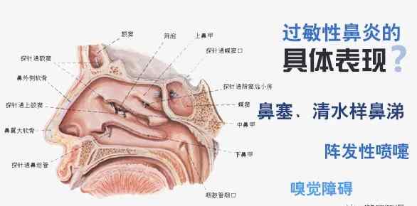 過敏性鼻炎用藥 過敏性鼻炎的7款藥物+5個聯(lián)合用藥方案