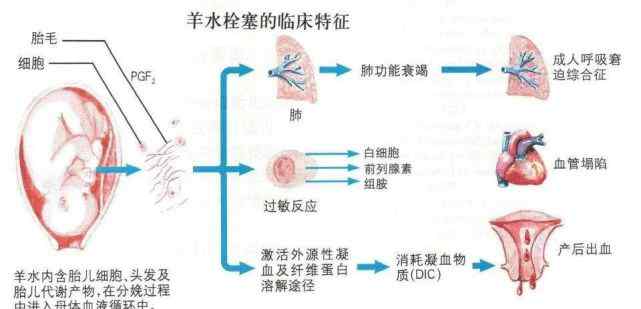 羊水栓塞死亡率 半個(gè)小時(shí)，人可能就沒(méi)了！死亡率高達(dá)90％疾病，5類寶媽最易中招！