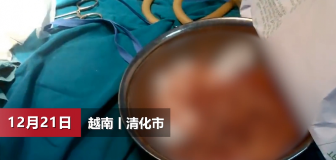 細(xì)思極恐！越南男子腹部取出上百條寄生蟲 膽小的別細(xì)看