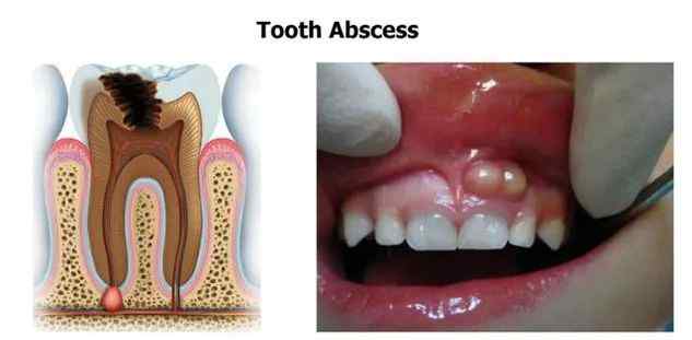 牙齦有白色的小膿包 牙齦出現(xiàn)白膿包，什么情況？