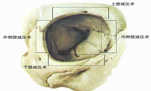 眼球突出治療 夏氏EPS突眼矯正術(shù)——突眼癥患者的福音