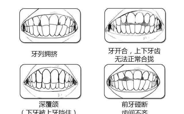 標準門牙咬合側面圖片 三步圖測法了解你的牙齒是否需要矯正？