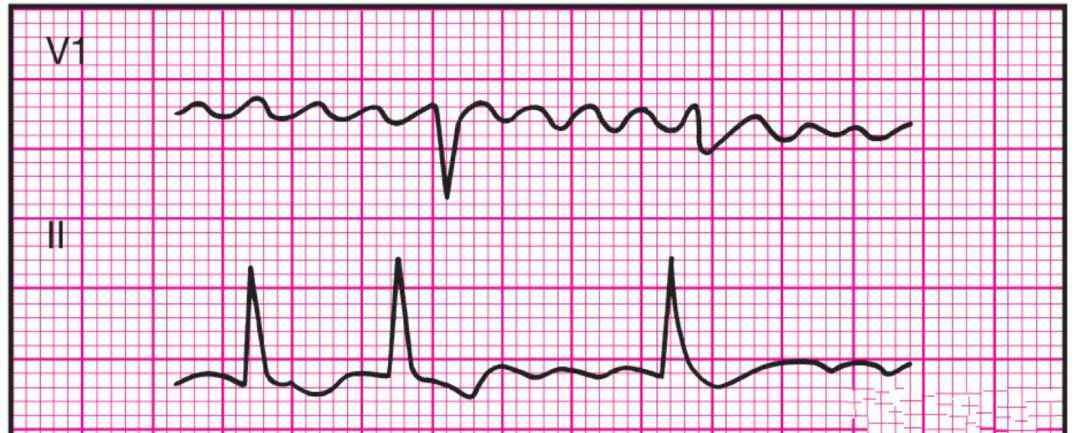 11種異常心電圖 14種異常心電圖的波形特點(diǎn)，建議收藏！