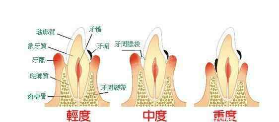 牙周炎口臭 牙疼，口臭，牙周炎，多半是它在嘴里作怪！