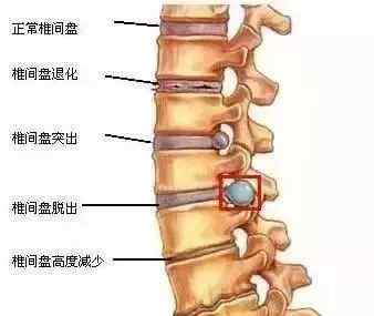 治療腰椎間盤突出 無需手術(shù)！每天堅(jiān)持一個(gè)動(dòng)作，在床上就能治療腰椎間盤突出