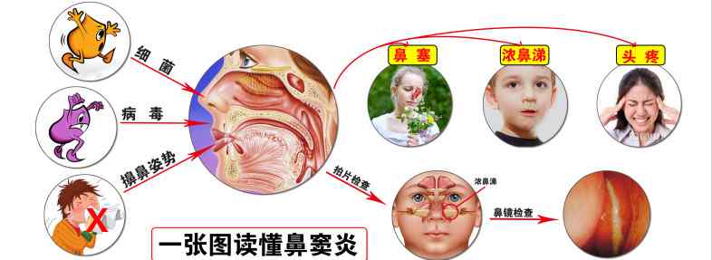 鼻炎治療 鼻竇炎的治療