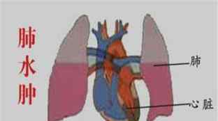 肺水腫是怎么引起的 新生兒肺水腫是怎么造成的？