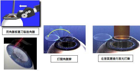 做準(zhǔn)分子激光近視手術(shù)，你必須滿足這4個(gè)條件.....