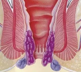 痔瘡的4種聯(lián)合用藥方案！