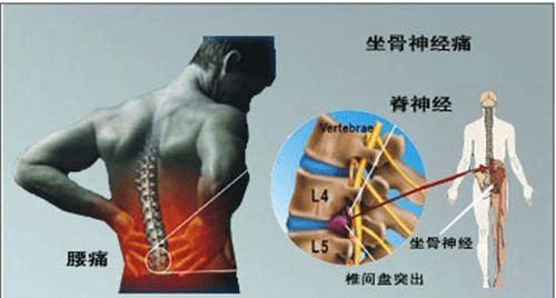 腰肌勞損怎樣緩解，最佳的治療方法是什么？