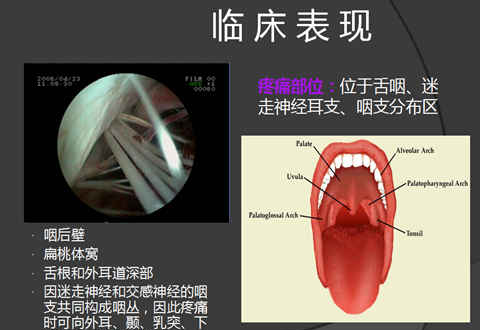 容易被誤診的“舌咽痛”，警惕舌咽神經(jīng)痛