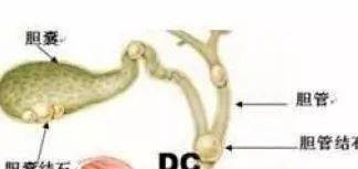 膽結(jié)石是怎么形成的，引發(fā)膽結(jié)石的6個原因，你中了幾個？