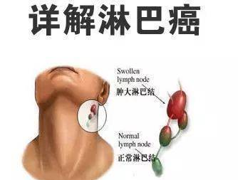 【警惕】5個(gè)癥狀是惡性淋巴瘤“警報(bào)”，全中的人可就危險(xiǎn)了！