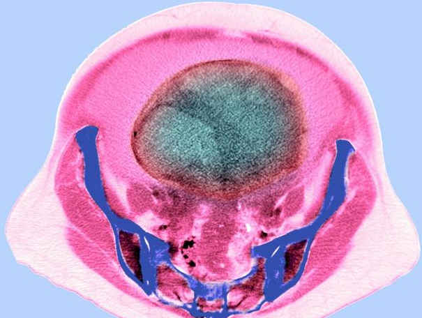 反復(fù)腹脹、腹痛？有可能是這個(gè)癌癥在搗鬼！