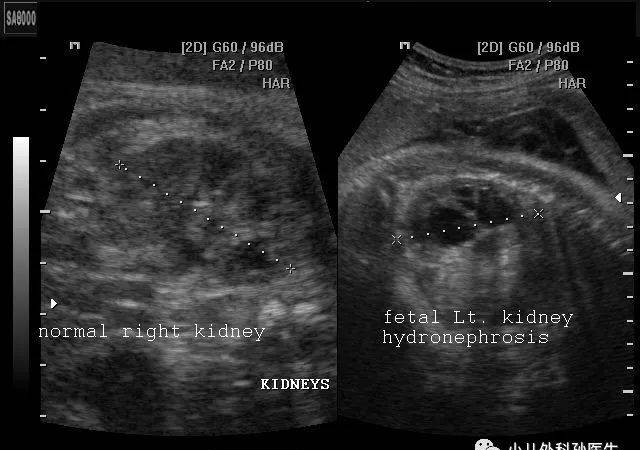 談談胎兒和小兒腎積水，不緊張，也別大意