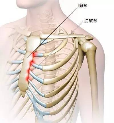 肋軟骨炎是怎么回事？